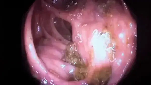 Imagem de endoscopia do intestino